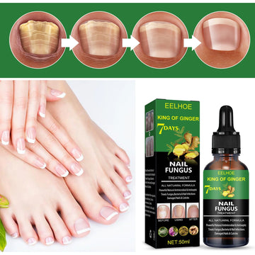 7 Days Nail Fungus Essence Hand and Foot Care Serum Removal Repair Gel Anti-Infection